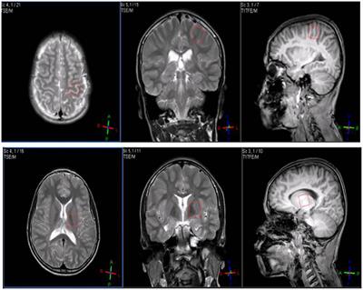 Transient Changes in Brain Metabolites after Transcranial Direct Current Stimulation in Spastic Cerebral Palsy: A Pilot Study